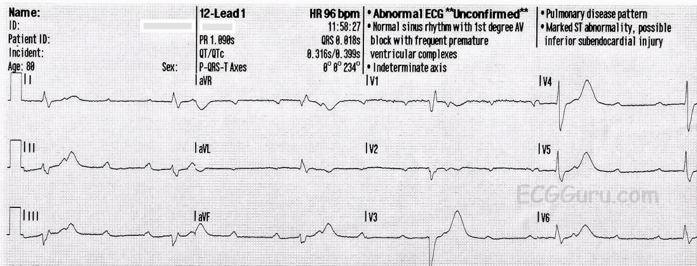 high-grade-av-block-second-degree-avb-type-ii-ecg-guru-instructor